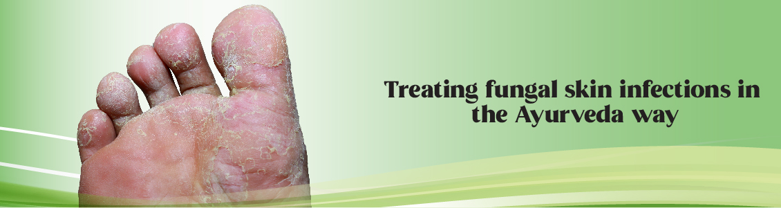 treating-fungal-skin-infections-in-the-ayurveda-way